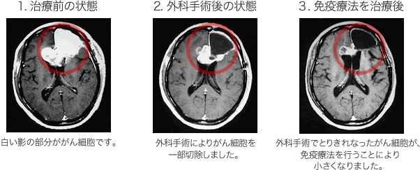 外科療法と免疫療法を併用した時の一例画像