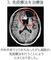 免疫療法を治療後